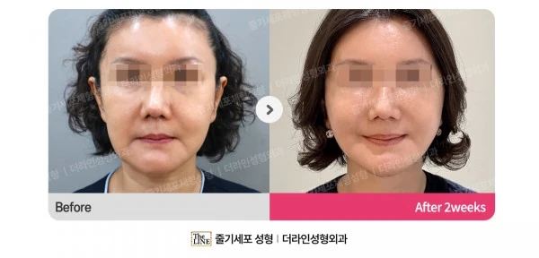 SVF Deep Plane Facelift before-and-after photo, before surgery - TheLINE Plastic Surgery