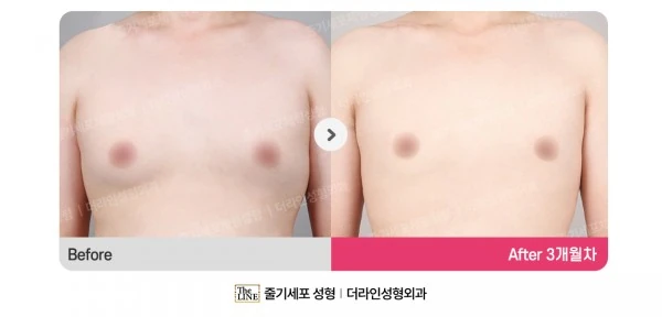 Male Gynecomastia Liposuction before-and-after photo, before surgery - TheLINE Plastic Surgery