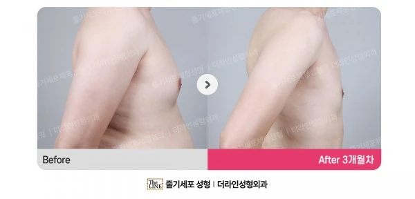 Male Gynecomastia Liposuction, before and after 3 months at Seoul Lipo Center