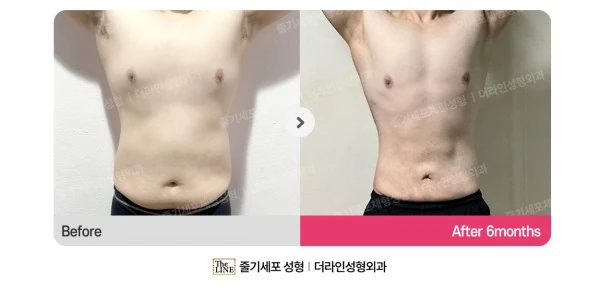 Male Gynecomastia, Abdominal Liposuction, before and after 6 months at Seoul Lipo Center