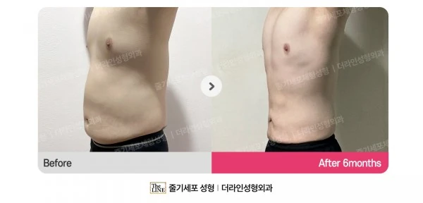 Male Gynecomastia, Abdominal Liposuction before-and-after photo, before surgery - TheLINE Plastic Surgery
