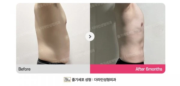 Male Gynecomastia, Abdominal Liposuction before-and-after photo, before surgery - TheLINE Plastic Surgery