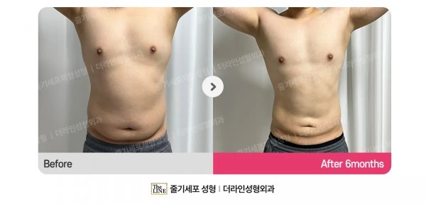 Male Gynecomastia, Abdominal Liposuction, before and after 6 months at Seoul Lipo Center