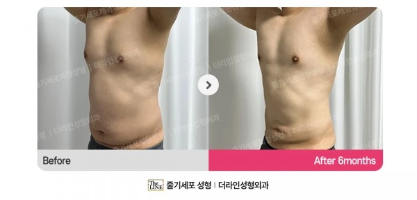 Male Gynecomastia, Abdominal Liposuction before-and-after photo, before surgery - TheLINE Plastic Surgery