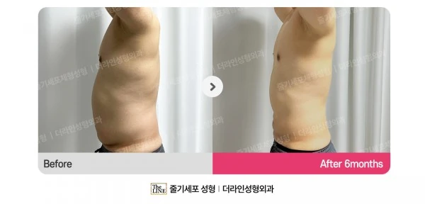 Male Gynecomastia, Abdominal Liposuction before-and-after photo, before surgery - TheLINE Plastic Surgery