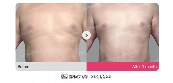 Male Gynecomastia Liposuction, before and after 1 month at Seoul Lipo Center