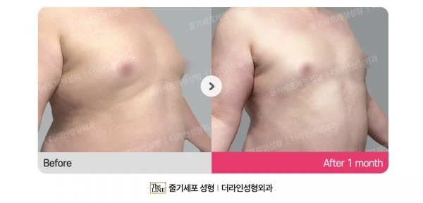 Male Gynecomastia Liposuction before-and-after photo, before surgery - TheLINE Plastic Surgery