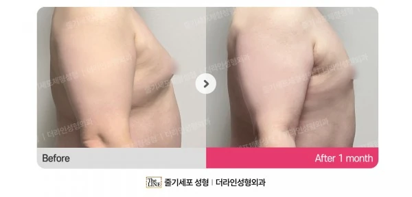 Male Gynecomastia Liposuction before-and-after photo, before surgery - TheLINE Plastic Surgery
