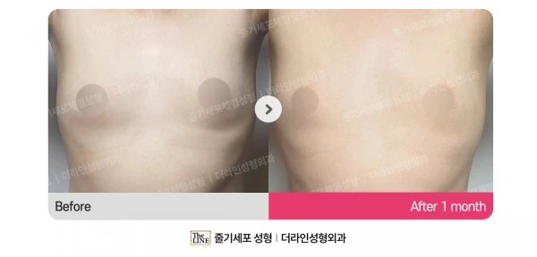 Male Gynecomastia Liposuction, before and after 1 month at Seoul Lipo Center