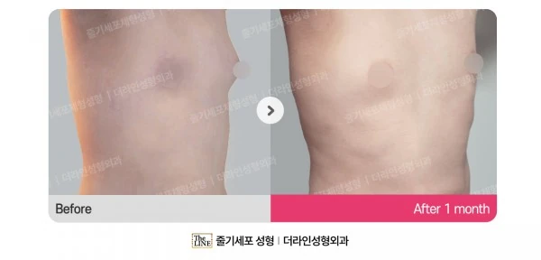 Male Gynecomastia Liposuction before-and-after photo, before surgery - TheLINE Plastic Surgery