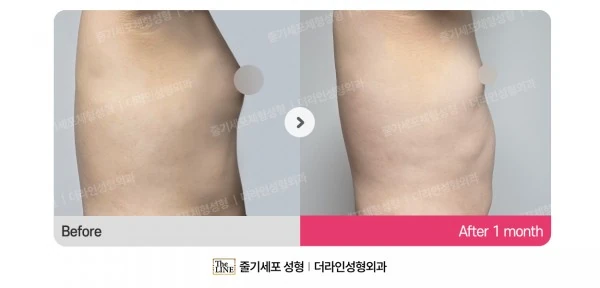Male Gynecomastia Liposuction before-and-after photo, before surgery - TheLINE Plastic Surgery