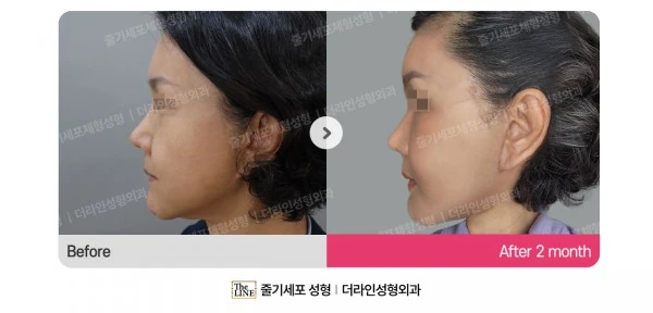 SVF Deep Plane Facelift - Scar Progress before-and-after photo, before surgery - TheLINE Plastic Surgery