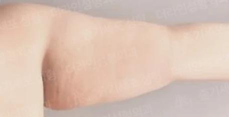 운동과 흡입으로 해결되지 않는 팔 처짐 - 더라인성형외과