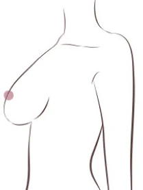 가성하수 - 가슴 밑선 기준으로 가슴이 전체적으로 아래에 있는 상태 - 더라인성형외과