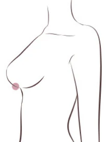 처진 가슴 3단계 - 유두가 3cm 이상 내려가 아래를 향한 상태 - 더라인성형외과
