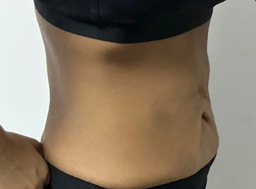 줄기세포가 풍부한 SVF 복부거상 - 2 - 더라인성형외과