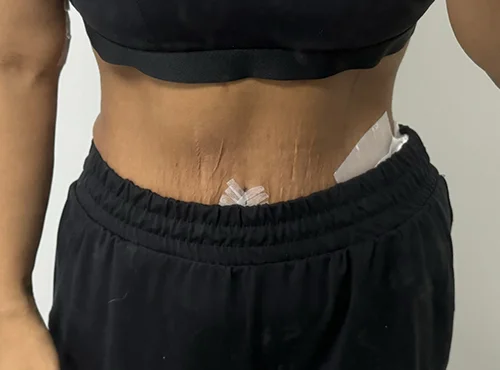 줄기세포가 풍부한 SVF 복부거상 - 3 - 더라인성형외과