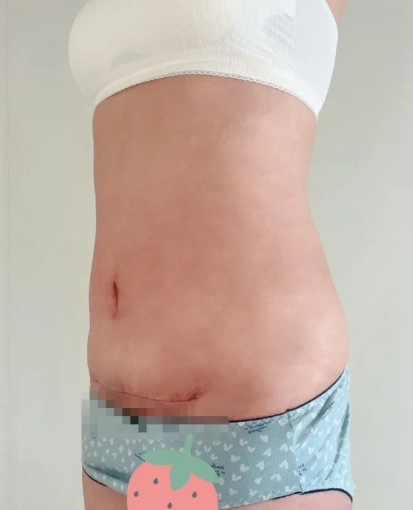줄기세포가 풍부한 SVF 복부거상 - 5 - 더라인성형외과