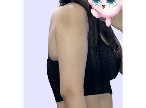 줄기세포가 풍부한 SVF 팔 거상 - 8 - 더라인성형외과