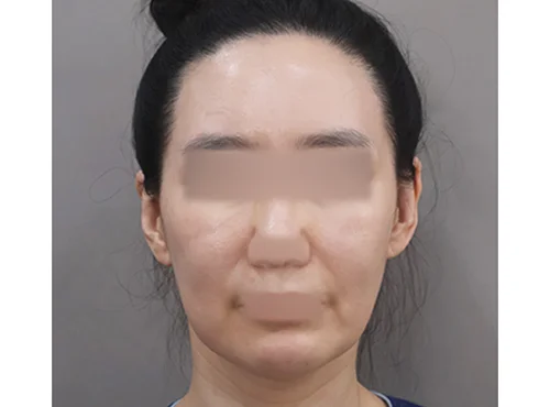 줄기세포가 풍부한 SVF 딥플레인 안면거상 - 1 - 더라인성형외과