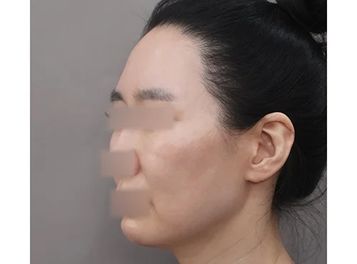 줄기세포가 풍부한 SVF 딥플레인 안면거상 - 2 - 더라인성형외과