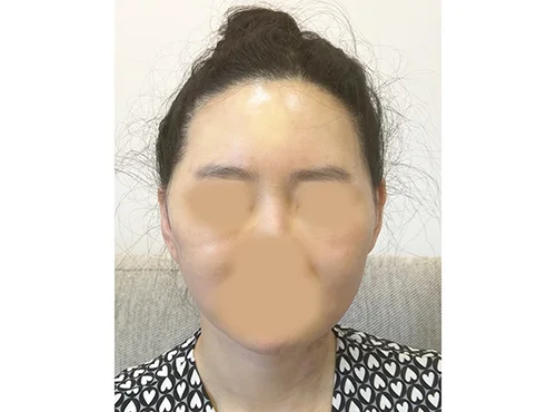 줄기세포가 풍부한 SVF 딥플레인 안면거상 - 3 - 더라인성형외과