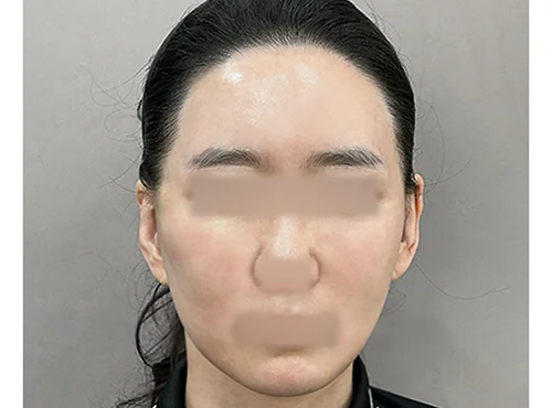 줄기세포가 풍부한 SVF 딥플레인 안면거상 - 5 - 더라인성형외과
