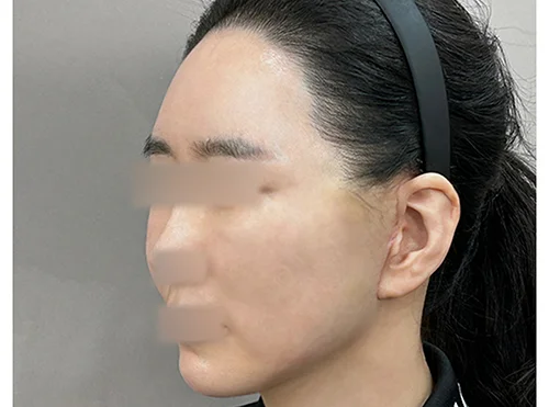 줄기세포가 풍부한 SVF 딥플레인 안면거상 - 6 - 더라인성형외과