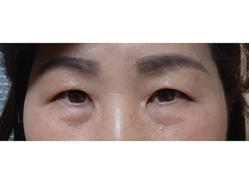 줄기세포가 풍부한 SVF 상안검 +하안검 - 1 - 더라인성형외과