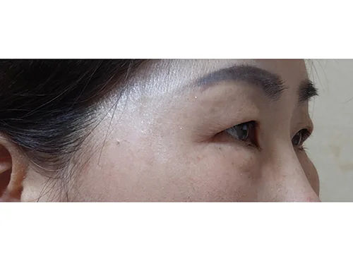 줄기세포가 풍부한 SVF 상안검 +하안검 - 2 - 더라인성형외과