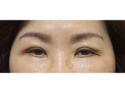 줄기세포가 풍부한 SVF 상안검 +하안검 - 3 - 더라인성형외과