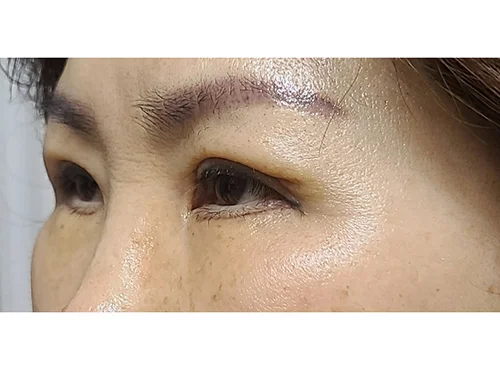 줄기세포가 풍부한 SVF 상안검 +하안검 - 4 - 더라인성형외과