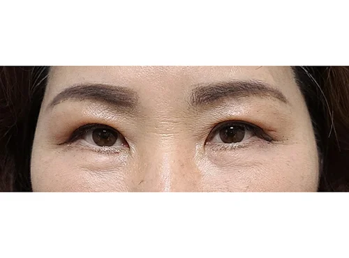 줄기세포가 풍부한 SVF 상안검 +하안검 - 5 - 더라인성형외과