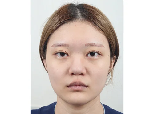 줄기세포가 풍부한 SVF 파워V, 눈,코 수술 - 1 - 더라인성형외과