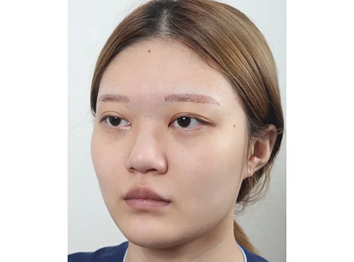 줄기세포가 풍부한 SVF 파워V, 눈,코 수술 - 2 - 더라인성형외과