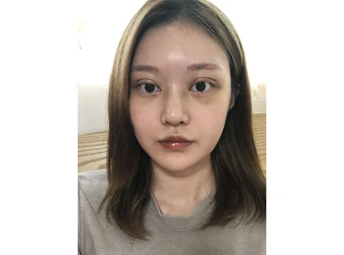 줄기세포가 풍부한 SVF 파워V, 눈,코 수술 - 3 - 더라인성형외과