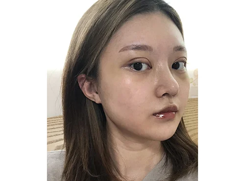 줄기세포가 풍부한 SVF 파워V, 눈,코 수술 - 4 - 더라인성형외과
