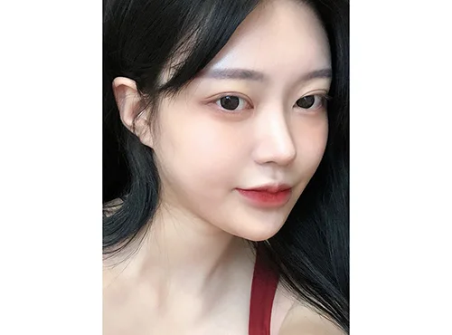 줄기세포가 풍부한 SVF 파워V, 눈,코 수술 - 6 - 더라인성형외과