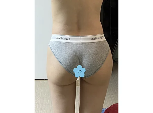 줄기세포가 풍부한 SVF 복부 지방흡입 (복부+러브핸들) - 4 - 더라인성형외과