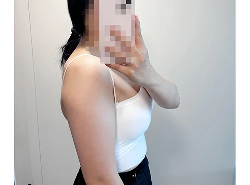 줄기세포가 풍부한 SVF 팔 지방흡입 - 1 - 더라인성형외과