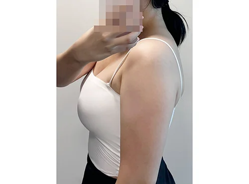줄기세포가 풍부한 SVF 팔 지방흡입 - 2 - 더라인성형외과