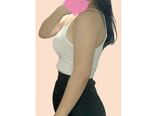 줄기세포가 풍부한 SVF 팔 지방흡입 - 6 - 더라인성형외과