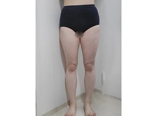 줄기세포가 풍부한 SVF 허벅지 지방흡입 - 1 - 더라인성형외과