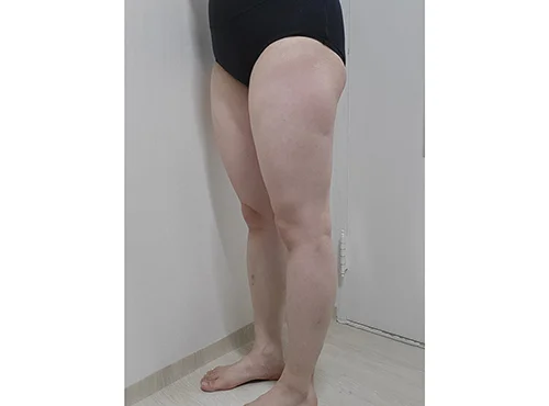 줄기세포가 풍부한 SVF 허벅지 지방흡입 - 2 - 더라인성형외과