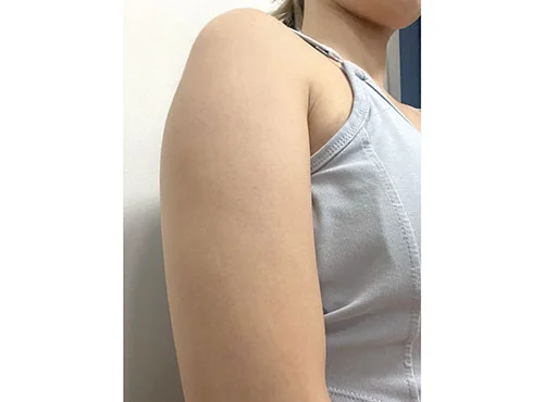 줄기세포가 풍부한 SVF 팔 지방흡입 (팔+부유방+팔뿌리) - 1 - 더라인성형외과
