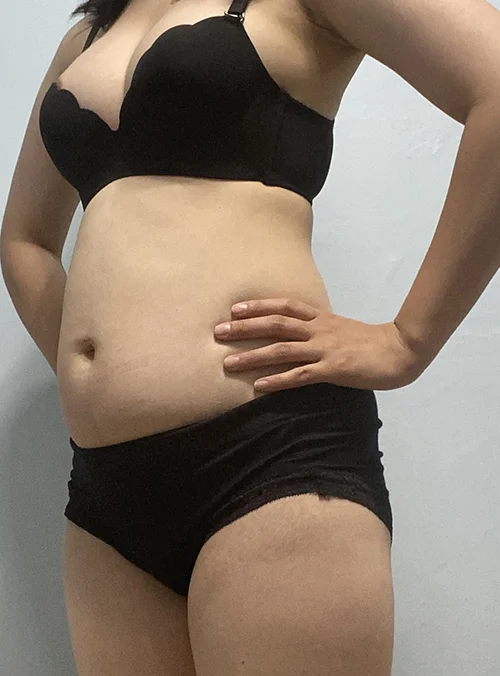 줄기세포가 풍부한 SVF 복부 지방흡입 - 1 - 더라인성형외과
