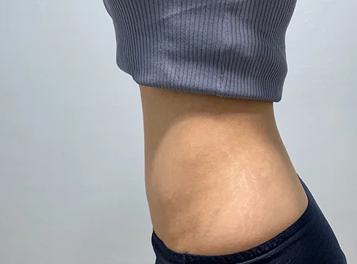 줄기세포가 풍부한 SVF 복부 지방흡입 - 4 - 더라인성형외과