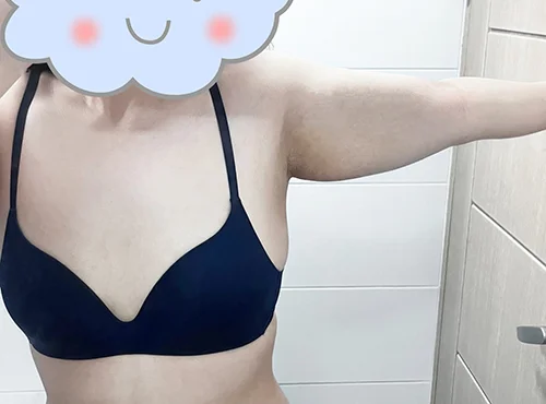 줄기세포가 풍부한 SVF 팔 지방흡입+ 팔거상 - 1 - 더라인성형외과