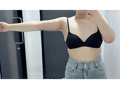 줄기세포가 풍부한 SVF 팔 지방흡입+ 팔거상 - 3 - 더라인성형외과