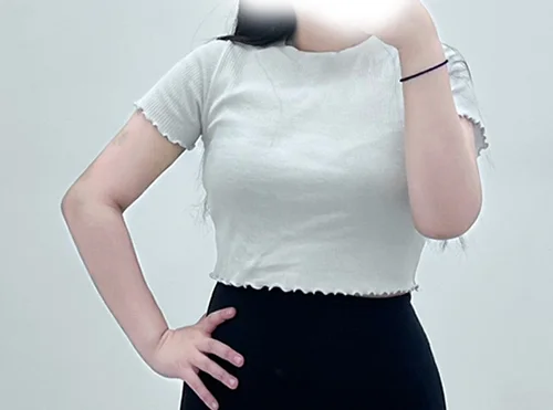 줄기세포가 풍부한 SVF 팔 지방흡입+ 팔거상 - 4 - 더라인성형외과
